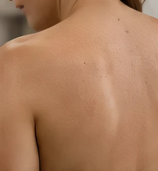 Cryotherapy & Skin Lesion Removal at Lumae Med Spa